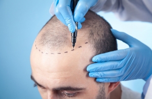 The Complete Guide to FUE Hair Transplant Surgery: What You Need to Know