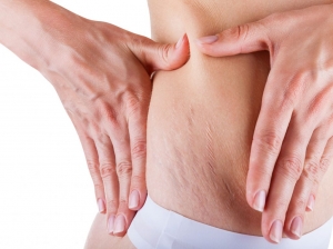 Effective Methods for Stretch Mark Removal: A Comprehensive Guide