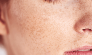 The Ultimate Guide to Clear Skin: Removing Freckles and Blemishes